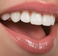 Affordable Porcelain Veneers in Melbourne image 1